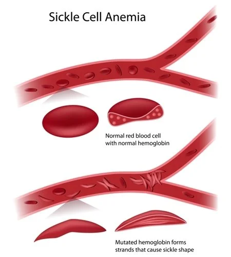 Cold at home with sickle cell disease