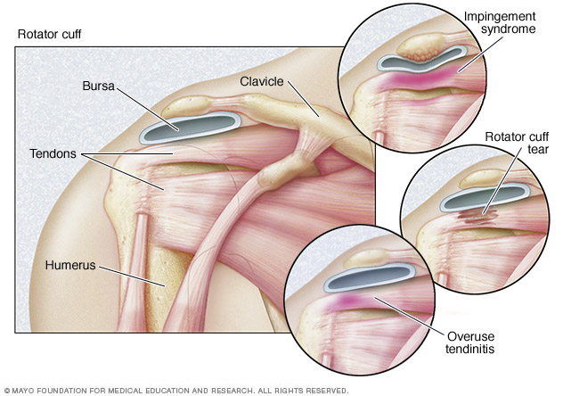 Torn Rotator Cuff