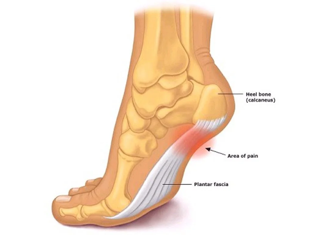 Plantar Fasciitis/Heel Spur Syndrome