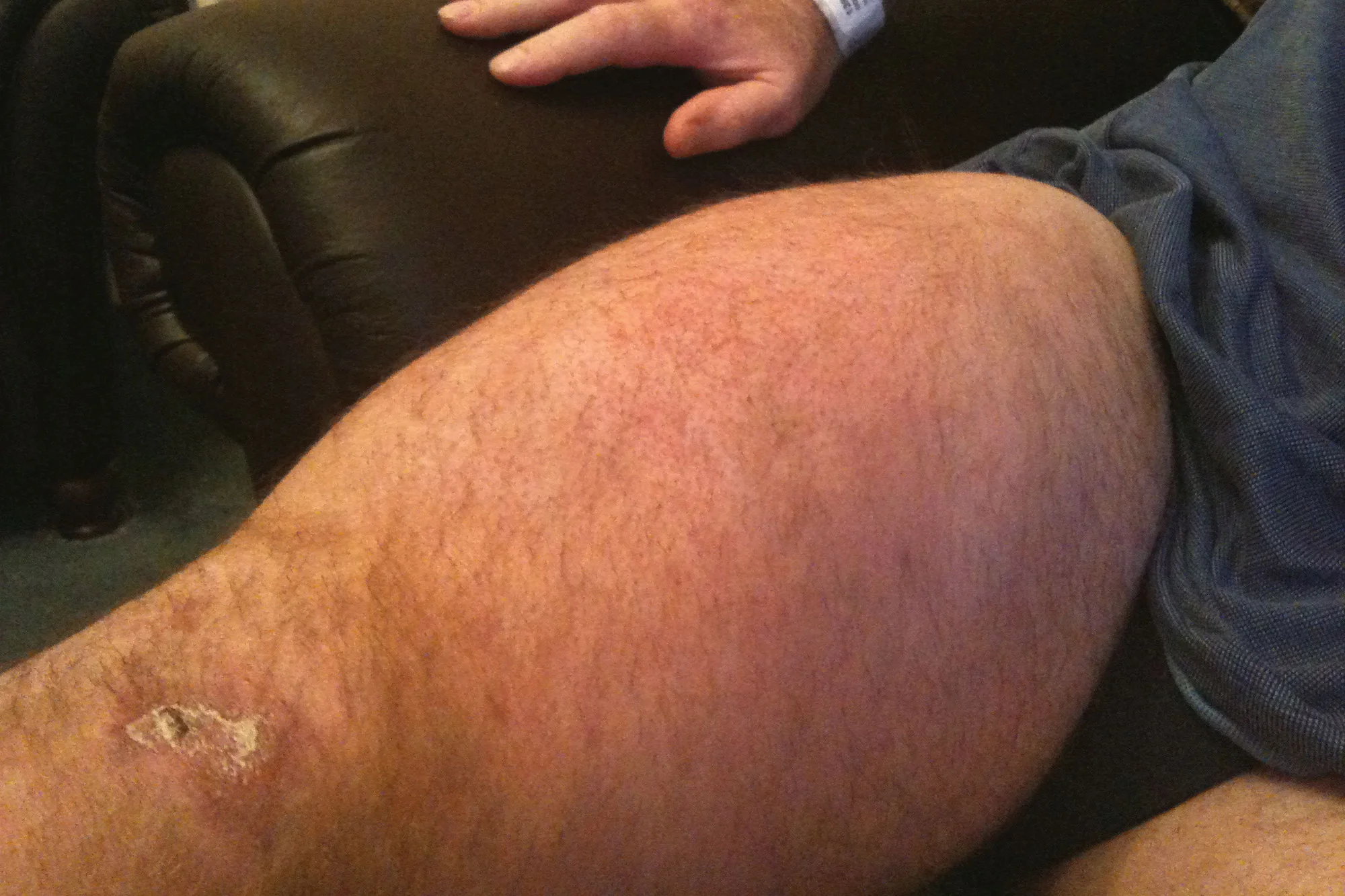 Paul's Multiple DVT and Haematoma