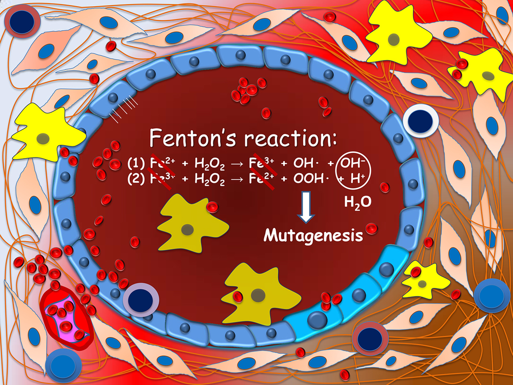 Figure 2. Carcinogenesis of endometriosis-associated ovarian neoplasms. Ovarian endometrioma (depicted) is lined by a single layer of endometriotic epithelium. Repeated hemorrhage as occurs during menstruation creates a highly inflammatory microenvironment. Reactive oxygen species are produced through the Fenton's reaction in the presence of abundance ferrous iron. These free radicals are highly genotoxic and may damage DNA of epithelial cells, a prerequisite step leading to gene mutations.