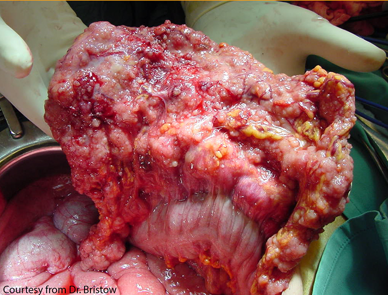 Gross picture of an ovarian high-grade serous carcinoma involving small intestine. High-grade serous carcinoma is the most common and aggressive type of ovarian epithelial carcinoma. It is always diagnosed at advanced stage (like this case illustrated). The 5-year survival rate is less than 40%.