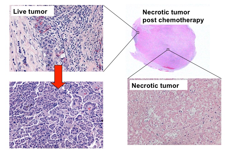 Figure 5. After chemotherapy (carboplatin and paciltaxel), the majority of ovarian HGSC cells die, forming tumor necrosis. However, tumor cells that are refractory to chemotherapy survive and expand to form a recurrent tumor. It is the recurrent chemoresistant tumor cells that cause cancer-related morbidity and mortality.
