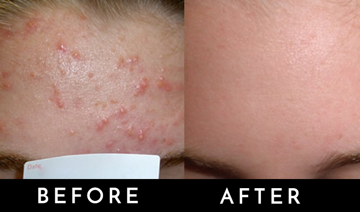 acne phototherapy.jpg