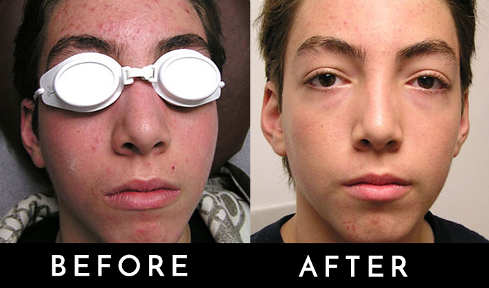 acne phototherapy 1.jpg