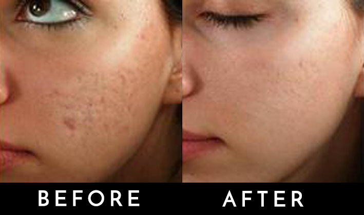 derma[en acne.jpg