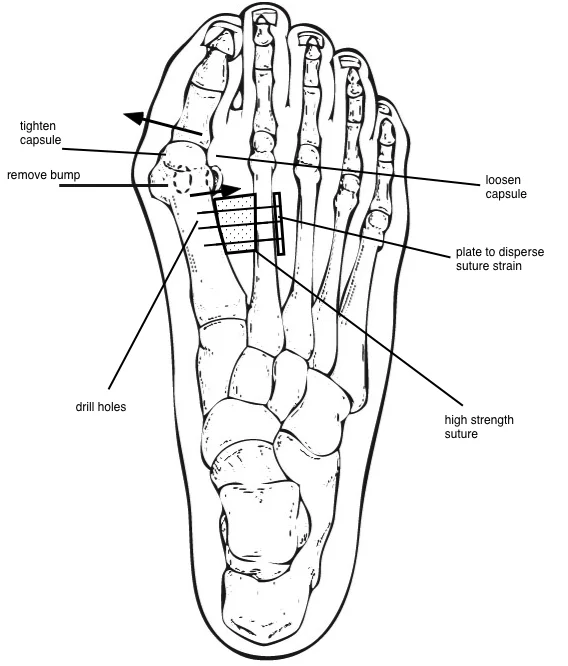 syndesmosis diagram final.jpg
