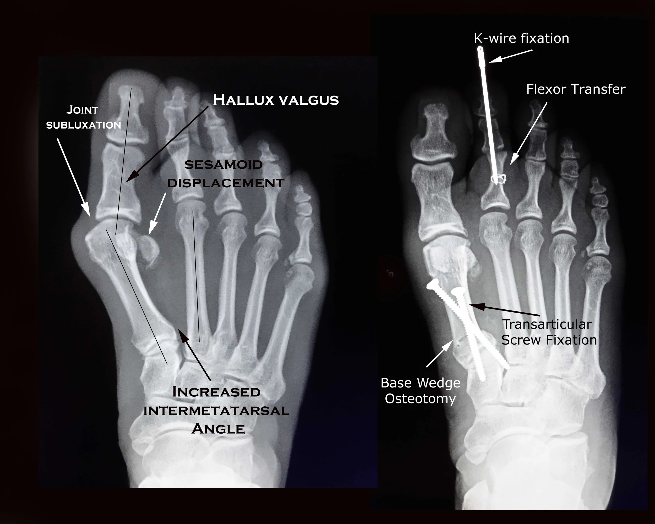Toe Realignment Surgery Bunion On Pinky Toe Surgery , Tailor’s Bunion: What Podiatrists Want ...