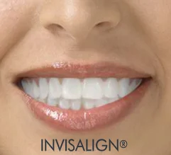 Invisalign-th.jpg