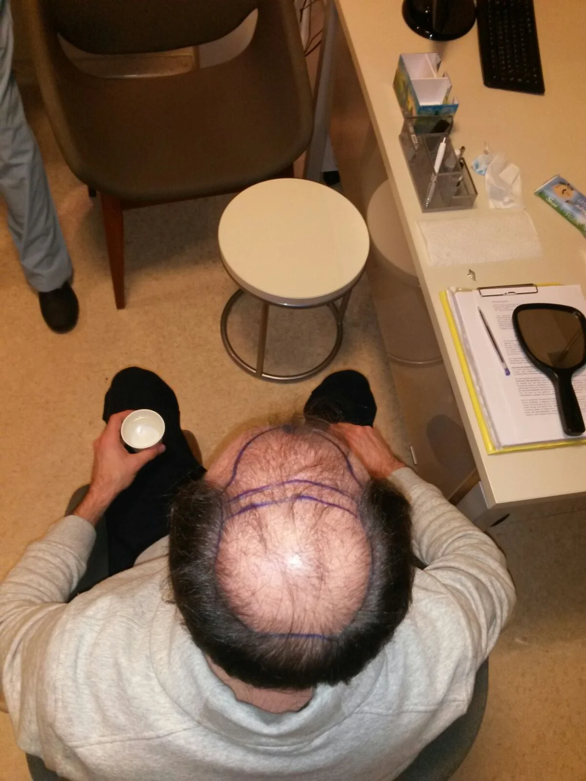 16.12.2015 Die Haarsituation vor dem Eingriff
