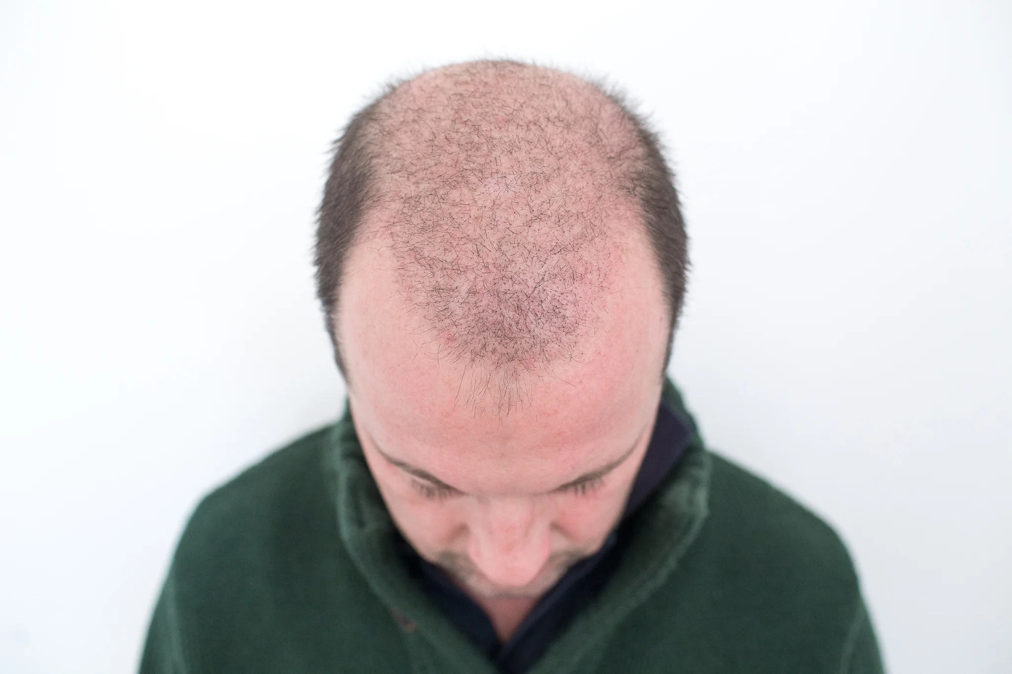 02.02.2016: die transplantierten Haare fallen aufgrund Sauerstoffmangels planmässig aus und die Wurzel bildet das dauerhaft bleibende Haar. Schön langsam kann man die kleinen Stopperln erkennen.