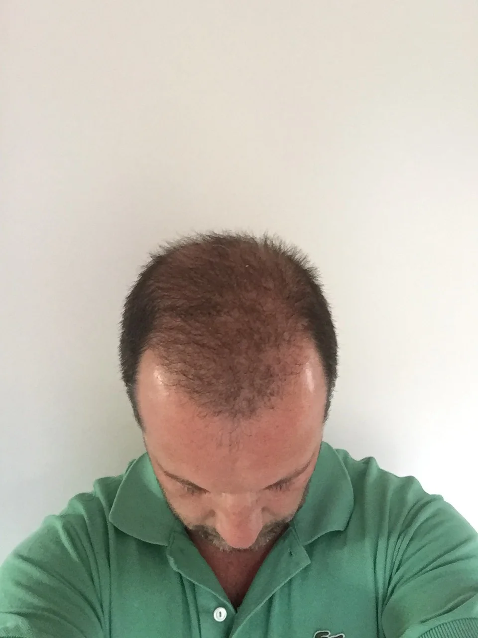 28.04.2016: und wieder deuliche dichtere Haare, ich hoffe es geht so weiter....!