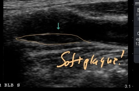 gasaway soft plaque without doppler_LI (3).jpg