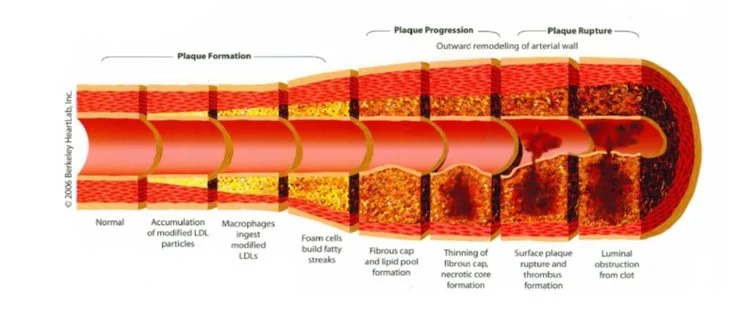 click the image to learn about ATHEROSCLEROSIS
