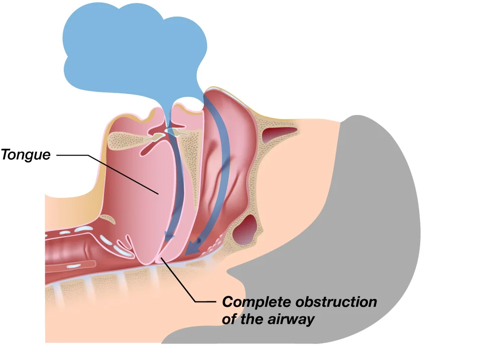 Signs and Symptoms of Sleep Apnea Dr. Tara Dental Edmonton