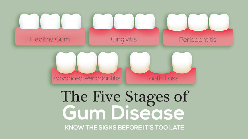 The Five Stages of Gum Disease — The McKenzie Center | Implants &  Periodontics