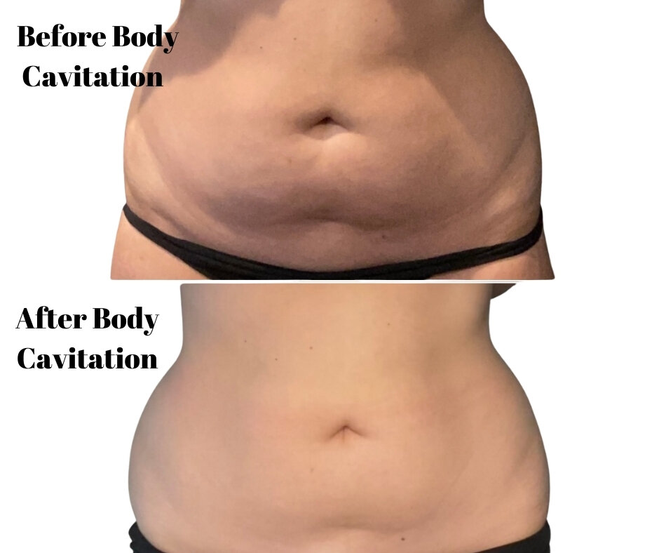 What is Fat Cavitation?