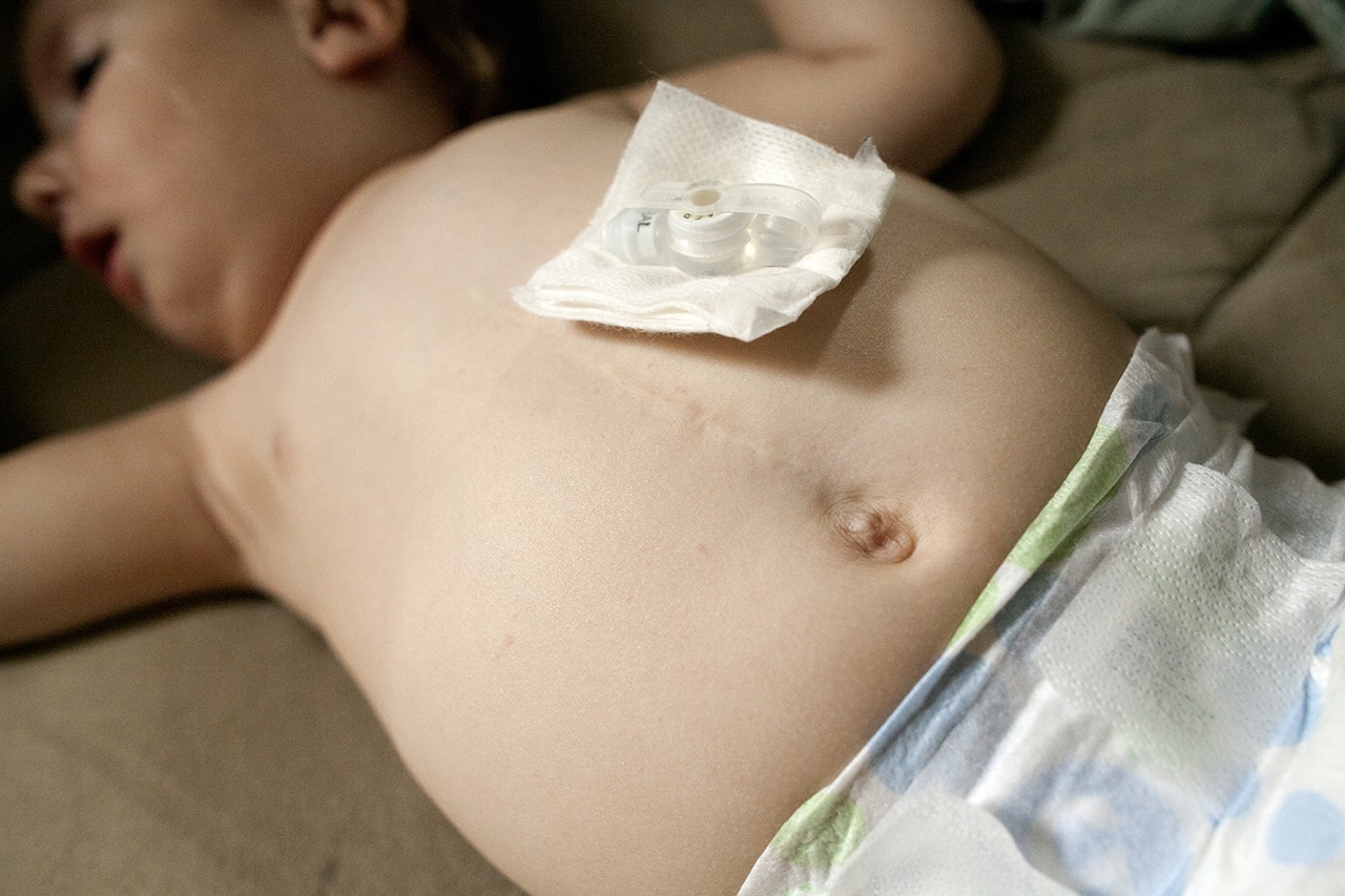 Paysen Davis lies after getting her diaper changed waiting for her mother to put her pajamas on her. Paysen has a scar down the center of her abdomen as a result of surgery, as well as a port for her feeding tube, which sets Davis apart from her brothers and other children her age.