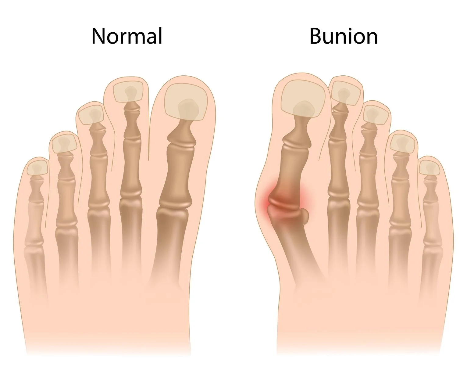 16911782_L_Bunion_Muscles_Feet_Bones.jpg