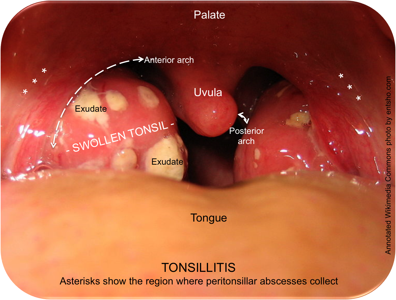 tonsillar hypertrophy score