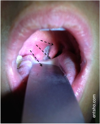 Photo D. Annotation to help visualisation of the location of the abscess in the peritonsillar space.