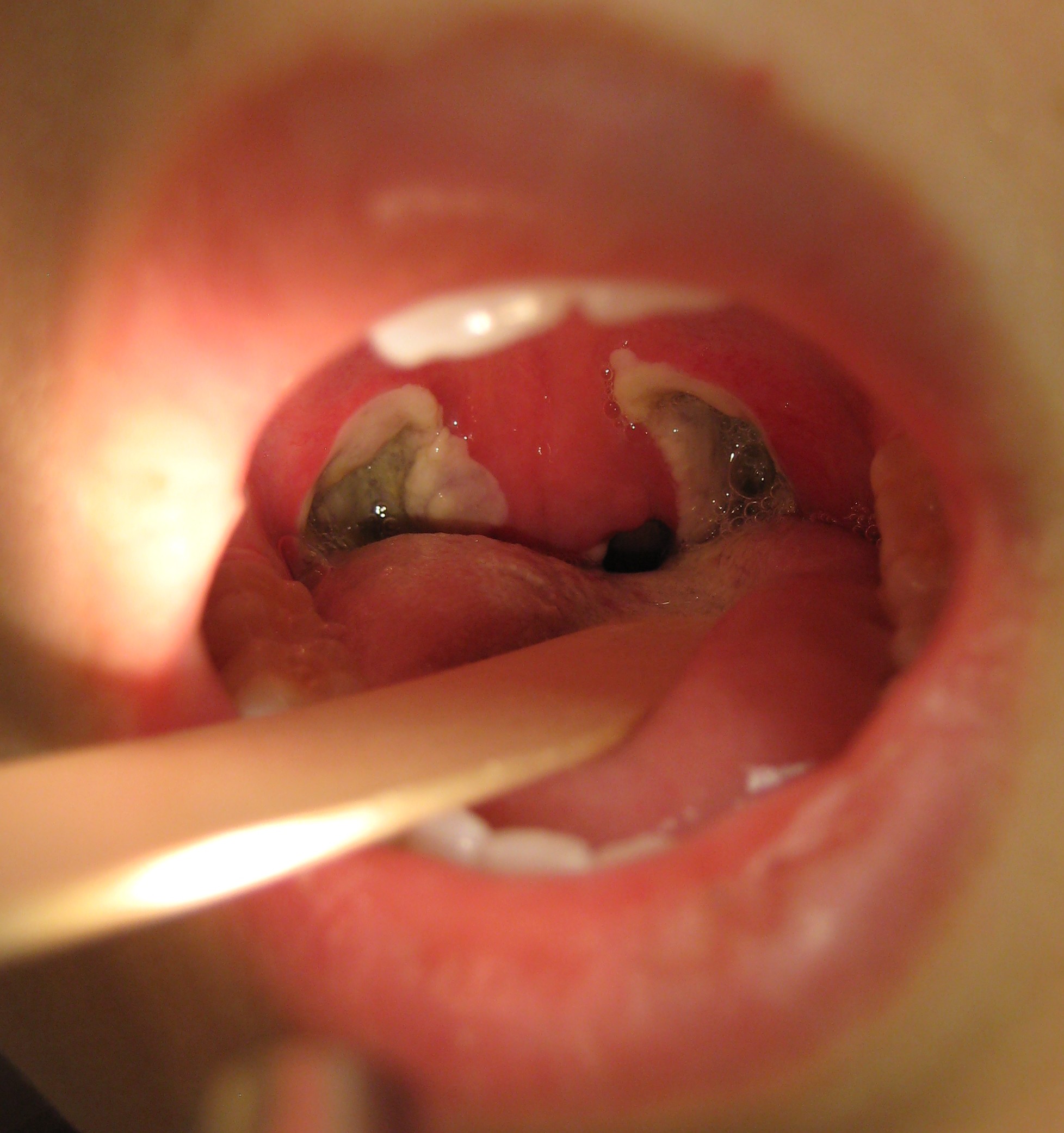 Photo A. Normal appearance of the oropharynx three days after tonsillectomy. Yellow/white/green slough in the tonsillar fossae is entirely normal and does not represent infection. With thanks to James Heilman MD, via Wikimedia Commons. 