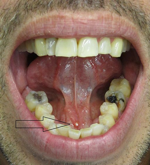 Infected Salivary Gland Entsho Com