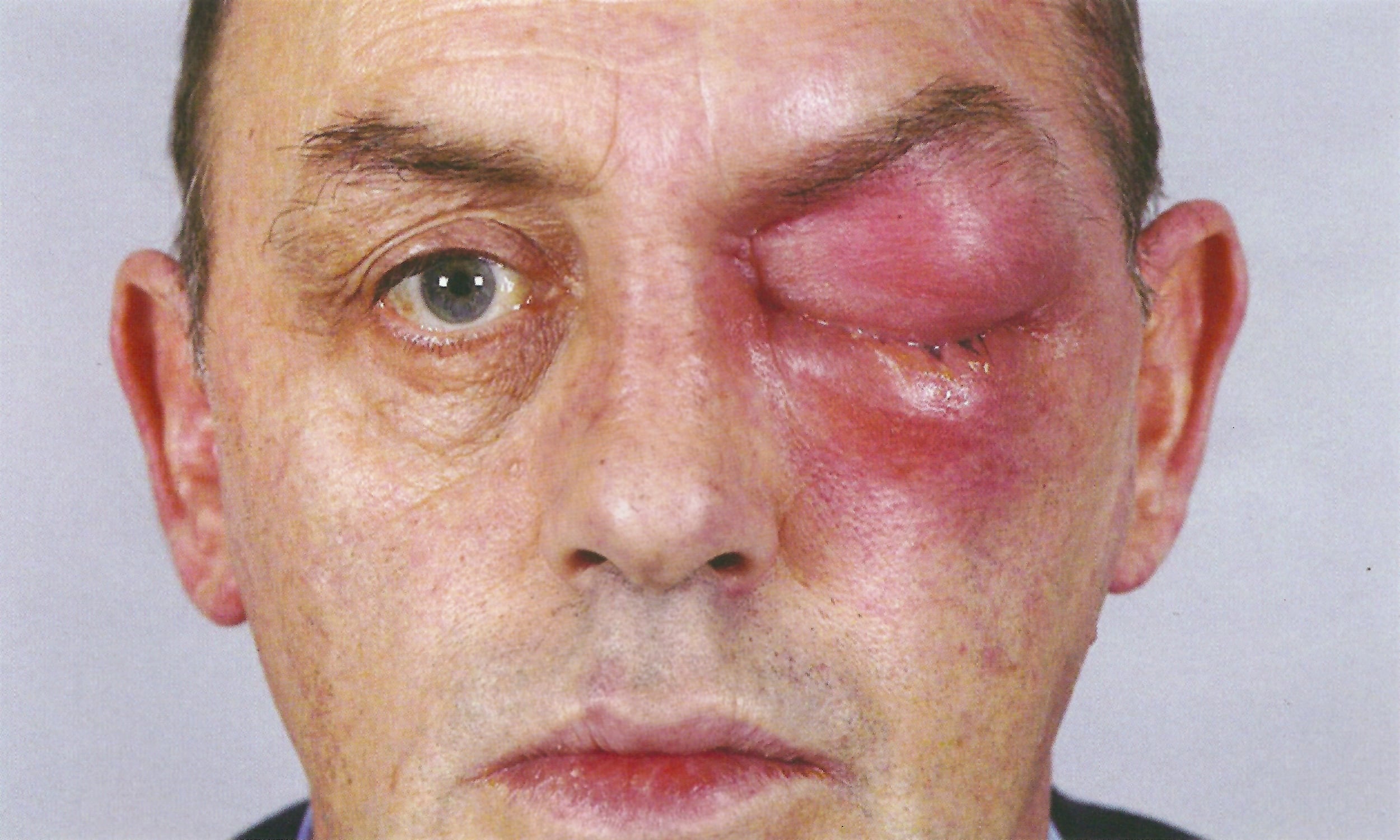 Photo: left post-septal (Chandler II) or orbital cellulitis. Note how the erythema involves the brow, orbit and maxilla.