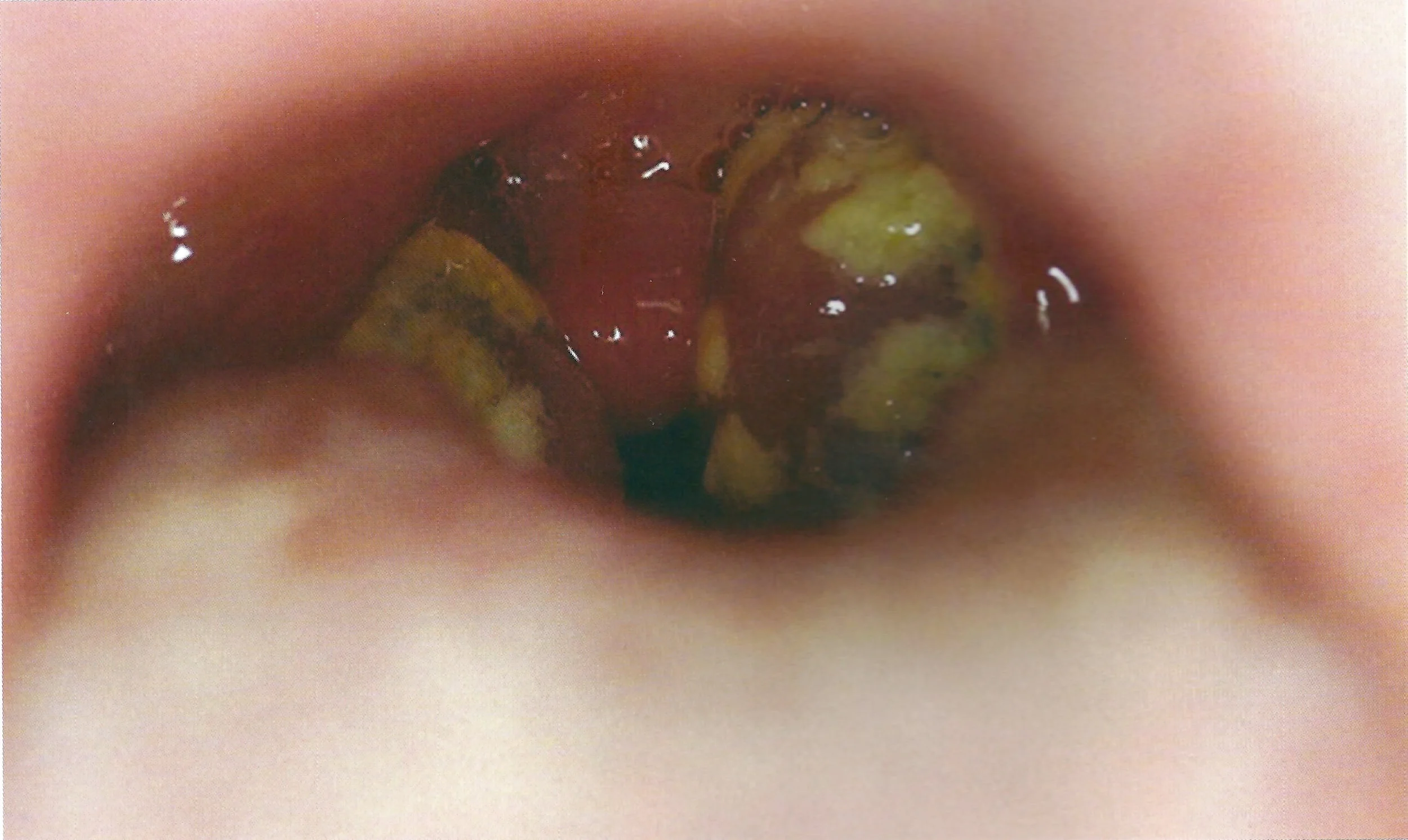 Photo: Tonsillitis in a different patient. Note the exudate on both sides and the position of the anterior arches.