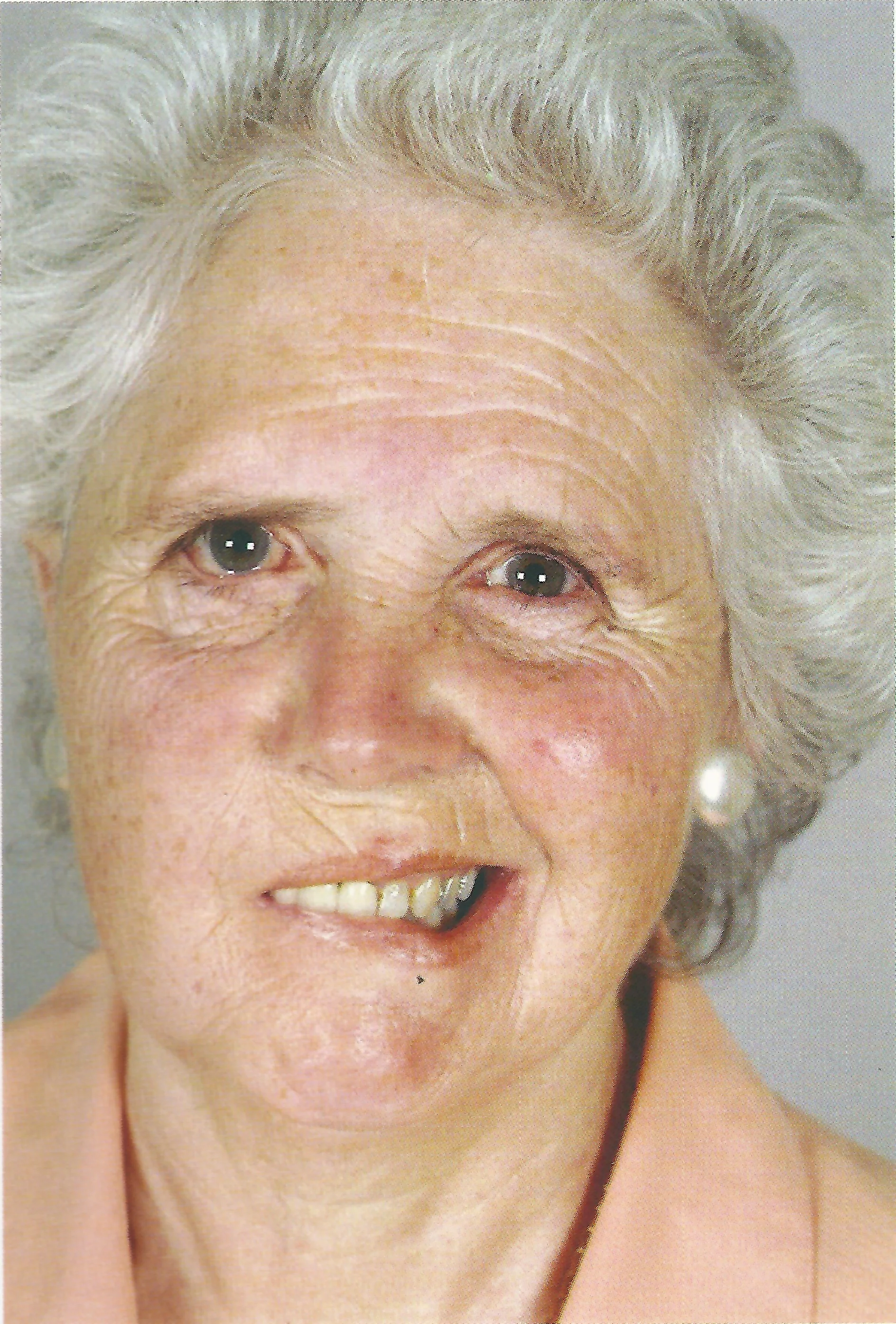 Photo - Right lower motor neurone facial palsy. Note the loss of the forehead and brow furrows as well as the nasolabial fold on the right. Similarly, the right depressor angulae oris is weak.