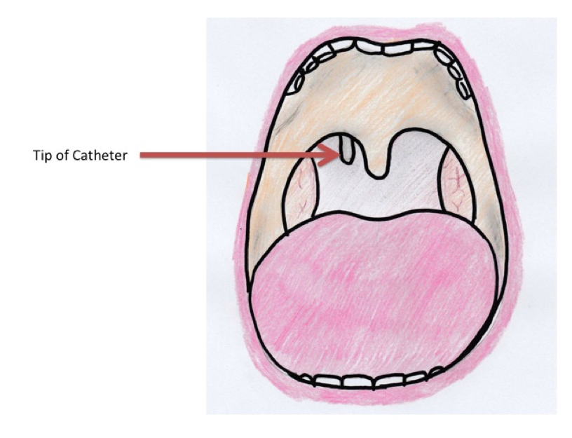 Look inside the oropharynx for the tip of the catheter