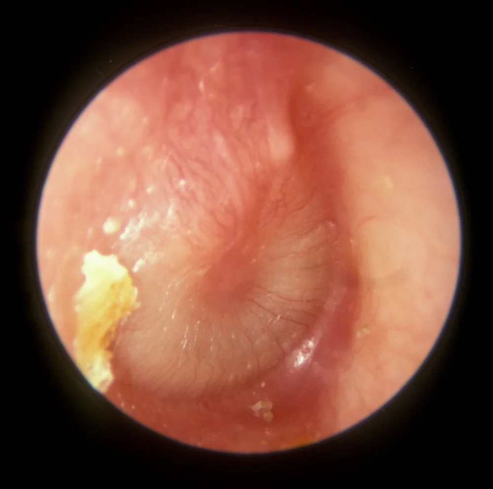 Acute Otitis Media Entsho Com