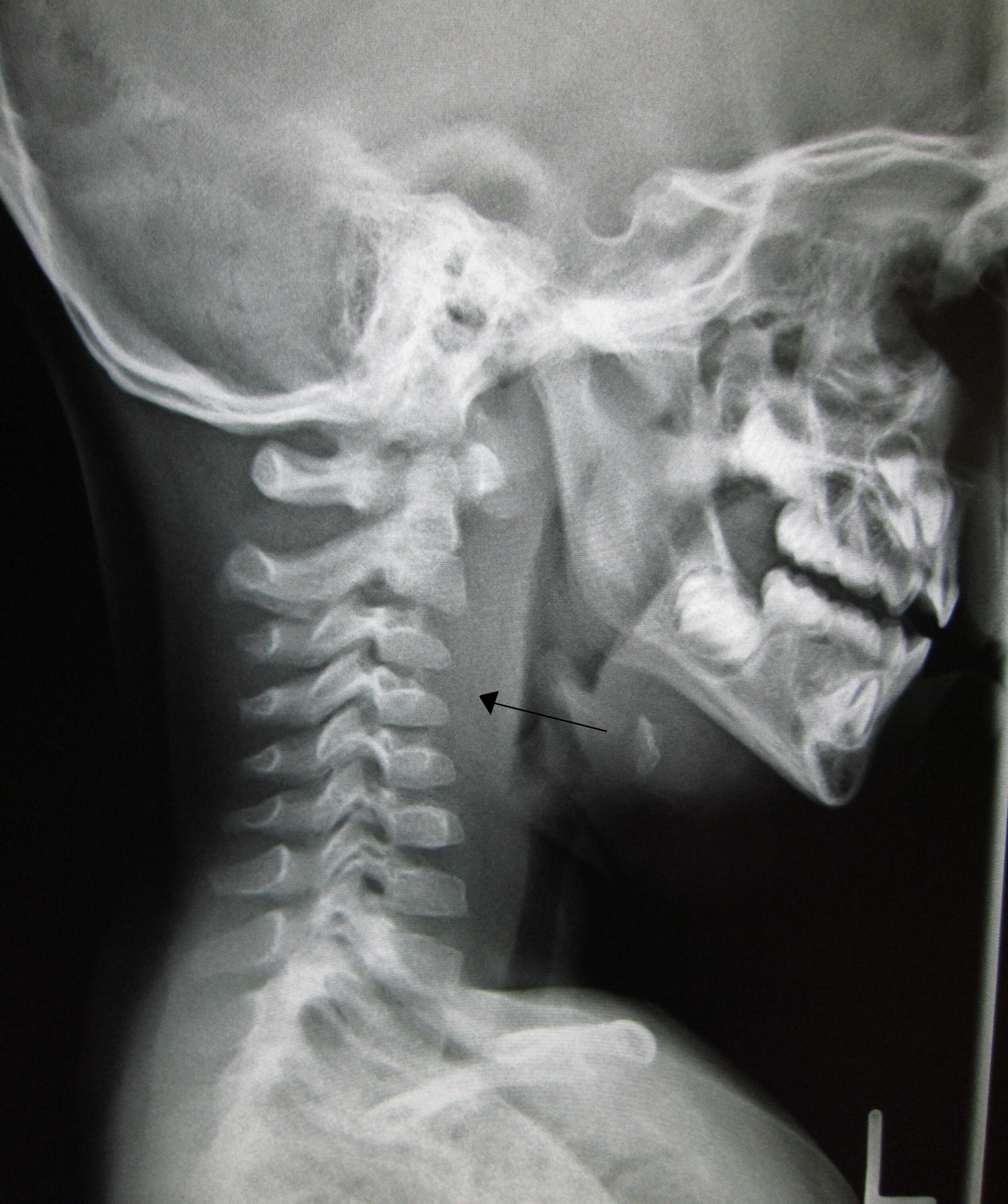 Deep neck space infections —