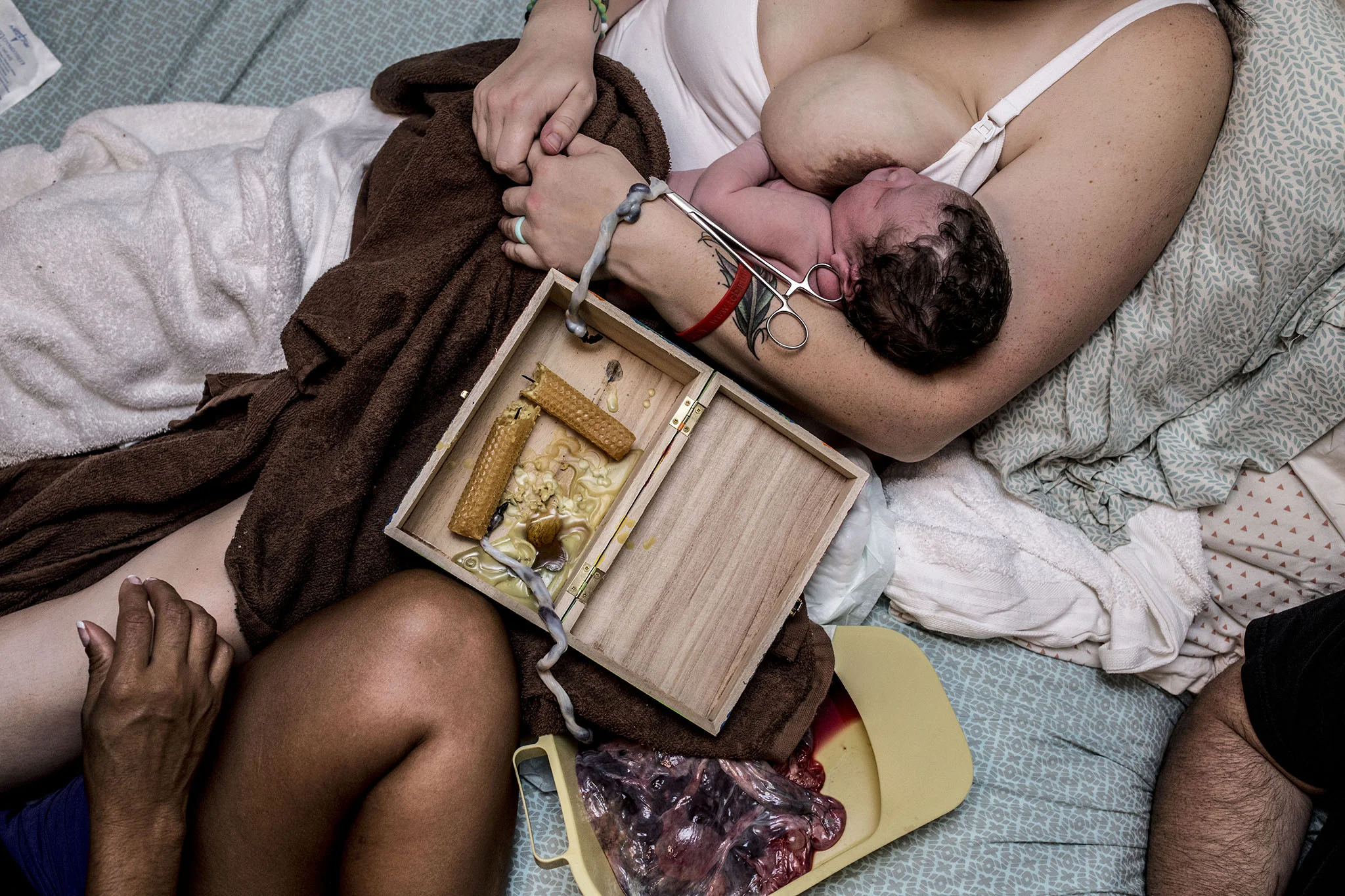 DFW cord burning at birth