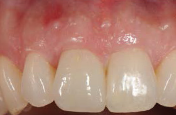 Dental Implants - Replace Missing Teeth Bellevue, WA