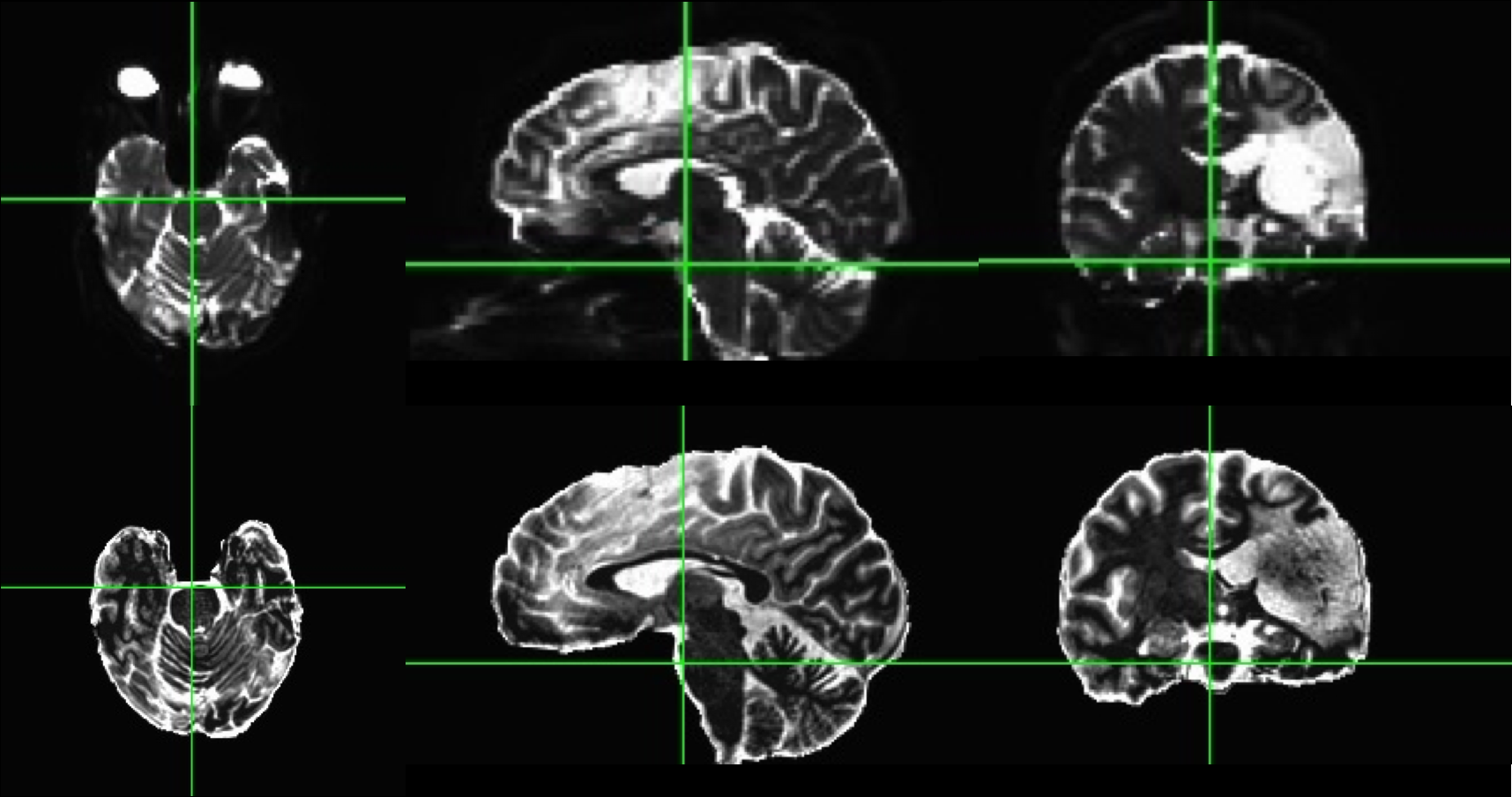 Advanced Distortion Correction (Top) and Structural T2 Image (Bottom)