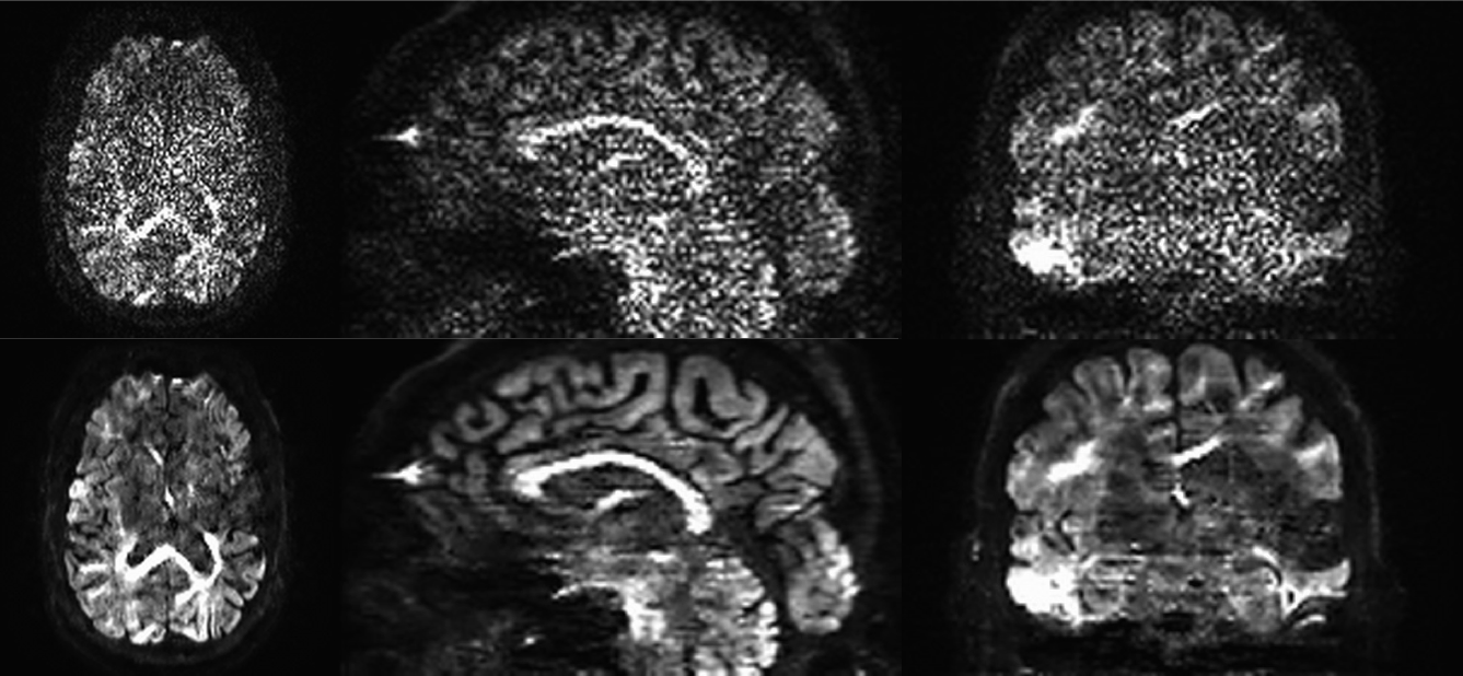 Top Row: B=3000 scan with high levels of noise Bottom Row: B=3000 scan after de-noising for Rician noise profile