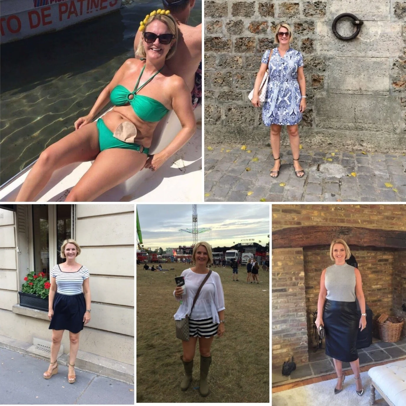 Now you see me now you don’t! Invisible though it is while I am dressed, my stoma and bag are always right there beside me.