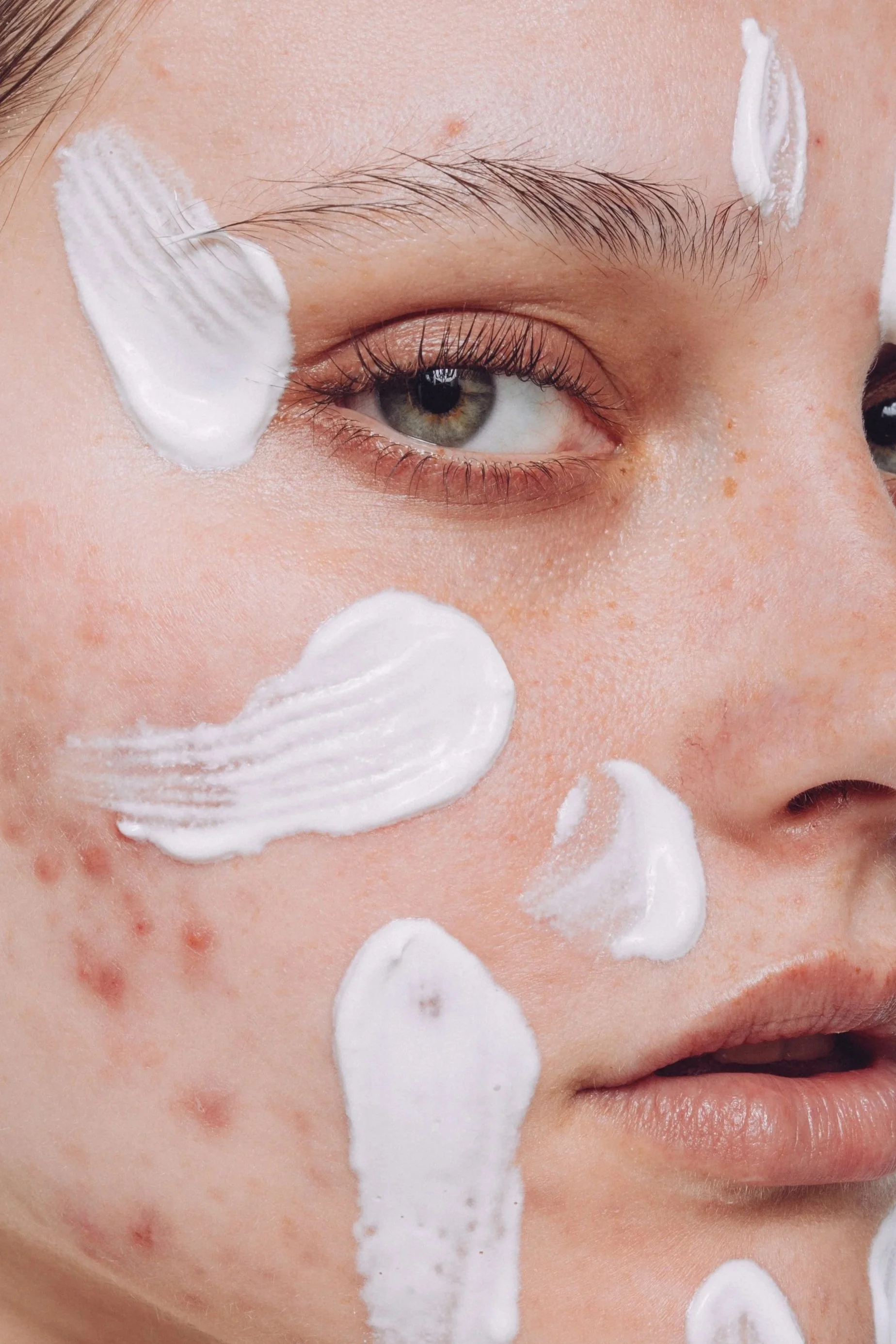 Close-up of a woman's side profile, she is facing off to the right, with moisturiser applied in small swipes on her cheeks, forehead, and chin. On her cheek and lower jar you can see some red acne.