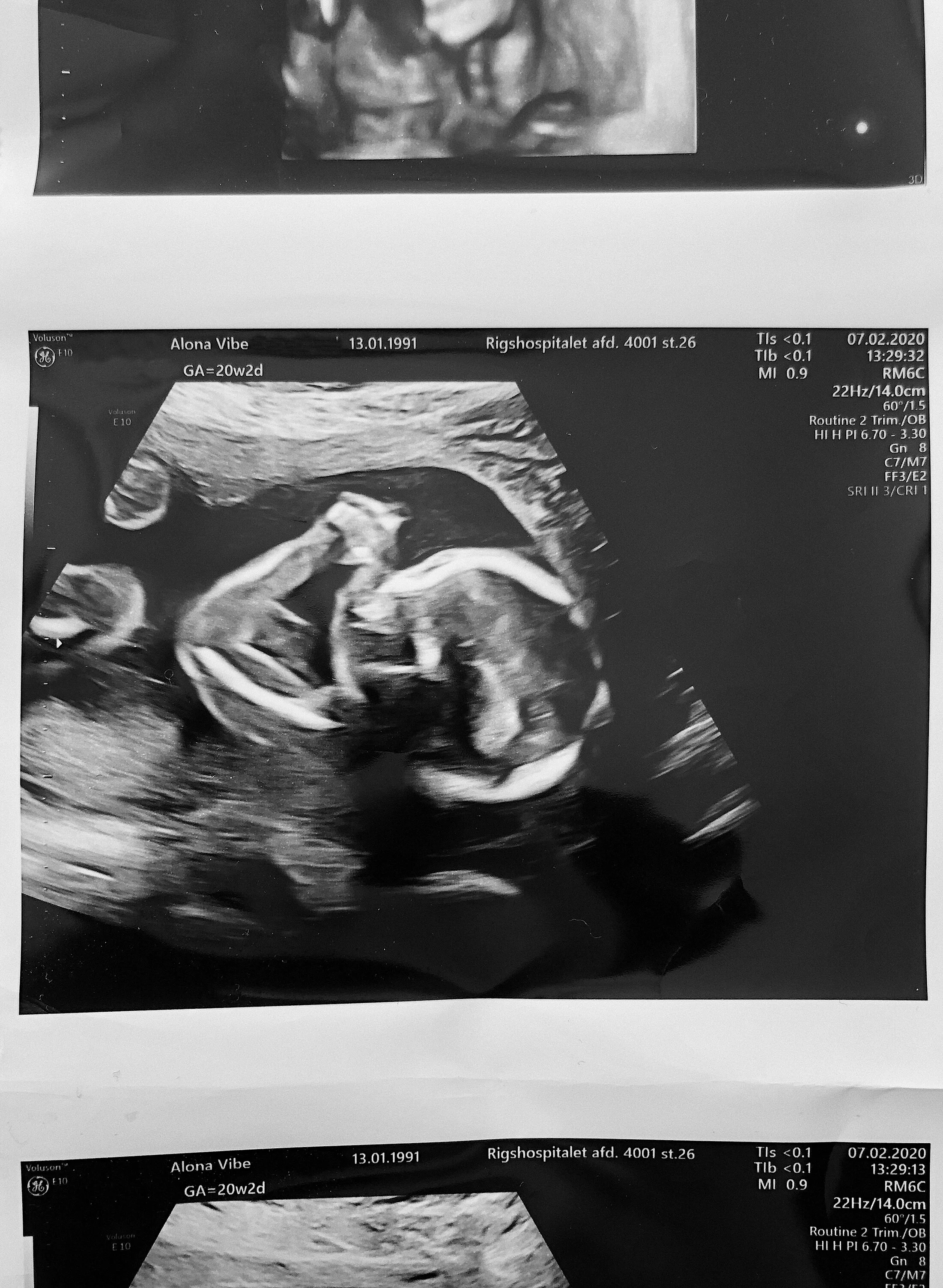 Scanningsbilleder fra misdannelsesscanningen i uge 20