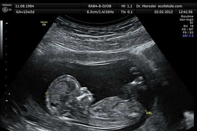 Non-invasive prenatal screening (NIPS): What patients need to know when being counseled about NIPS