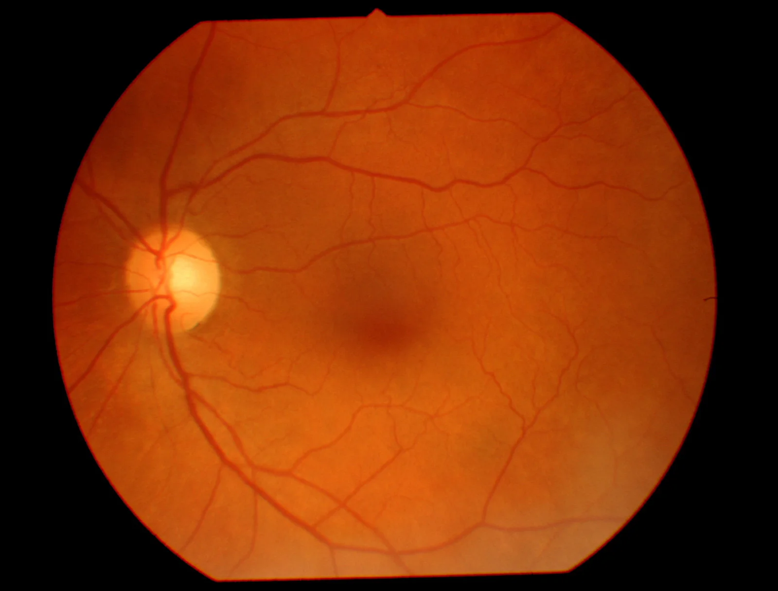 EYE HEALTH CENTER OF TROY - fundus exam