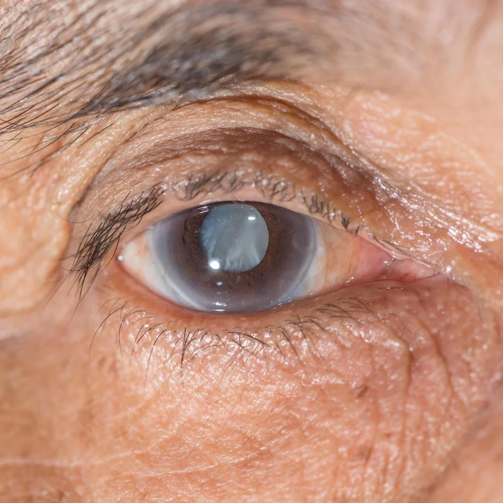 cataract of the eye