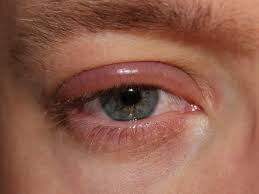 example of eye with Blepharitis