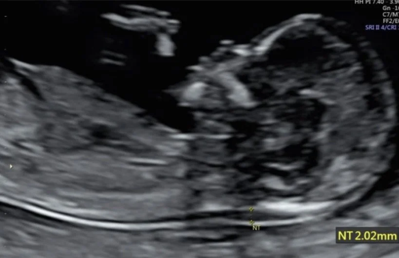 Selective Abortion and Pro Choice’s Selective Advocacy