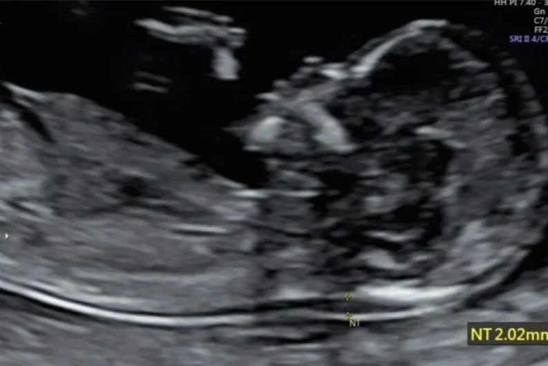 Selective Abortion and Pro Choice’s Selective Advocacy