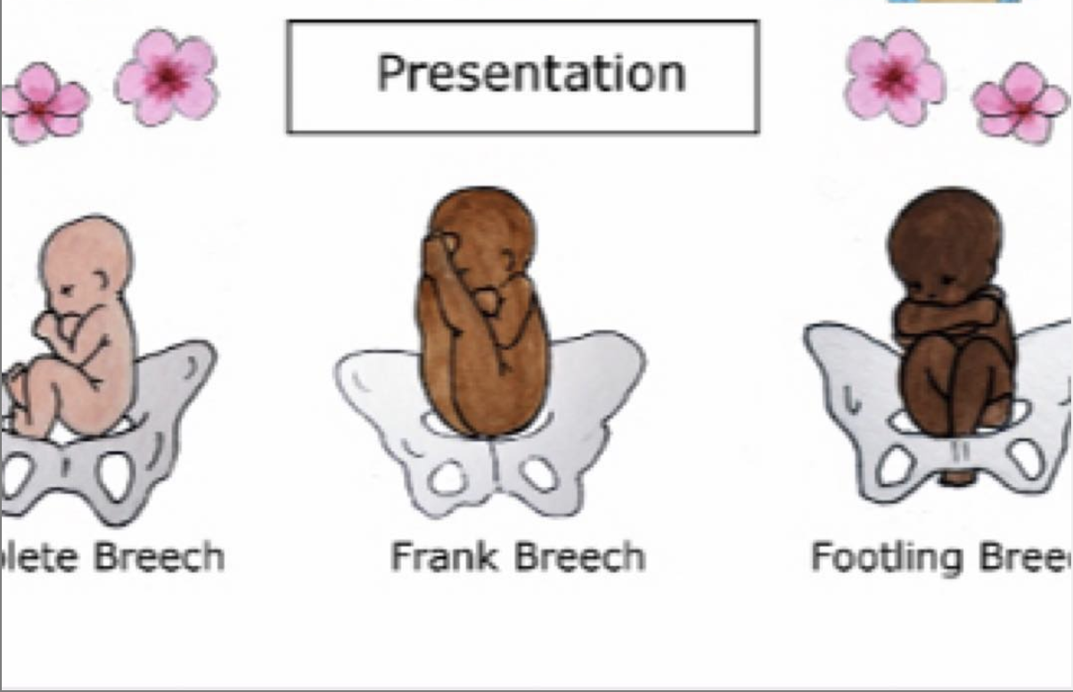 WHAT TO DO WHEN YOUR BABY IS BREECH OR TRANSVERSE Holistic Health what-to-do-when-your-baby-is-breech-or-transverse-holistic-health