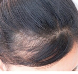 Hair Loss Reasons and Solutions — Aspen Hair, Beauty & Laser Hair Removal