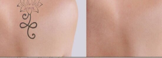 How Laser Tattoo Removal Works — Aspen Hair, Beauty & Laser Hair Removal