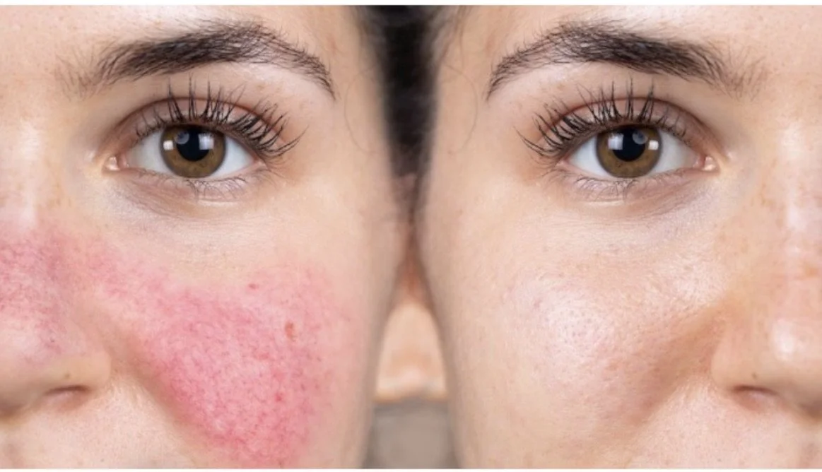 Rosacea Treatment Blog